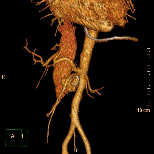 File:Aorto-left renal vein fistula (Radiopaedia 45534-49628 D 2).jpg