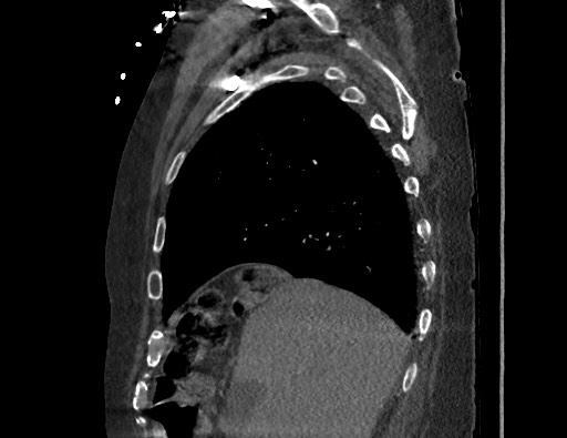 Aortoesophageal fistula with endovascular repair (Radiopaedia 73781-84592 Sagittal C+ CTPA 40).jpg