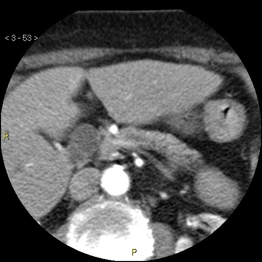 File:Aortoiliac occlusive disease (Radiopaedia 16828-16548 A 53).jpg