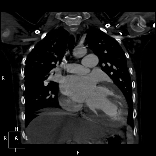 File:Aortopulmonary septal defect (Radiopaedia 41990-45013 Coronal C+ CTPA 27).jpg