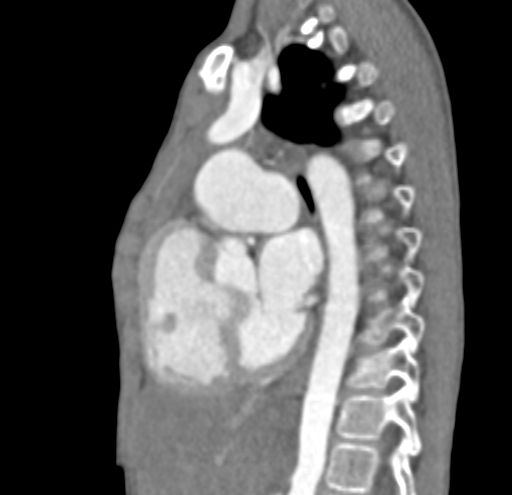 File:Aortopulmonary window, interrupted aortic arch and large PDA giving the descending aorta (Radiopaedia 35573-37074 C 21).jpg
