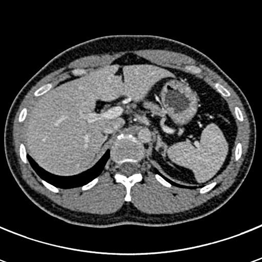 Apical lung mass mimic - neurogenic tumor (Radiopaedia 59918-67521 A 82).jpg