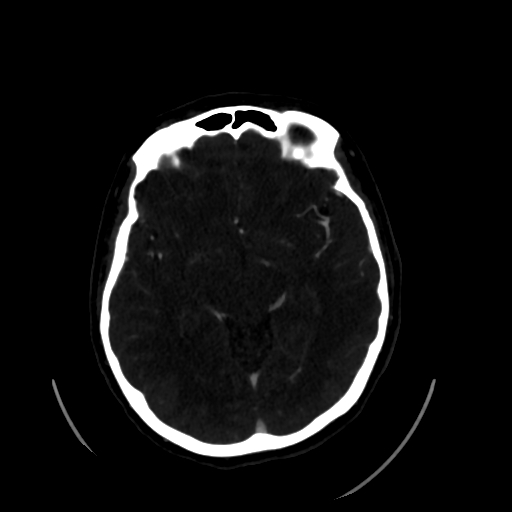Aplasia of the internal carotid artery (Radiopaedia 61082-68960 A 31).jpg