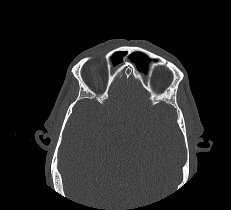 Aplastic maxillary sinuses (Radiopaedia 60030-67561 Axial non-contrast 56).jpg