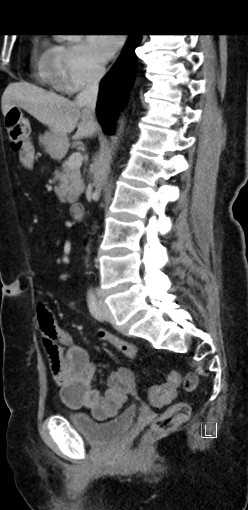 Appendiceal hemorrhage (Radiopaedia 70830-81025 Sagittal C+ delayed 54).jpg