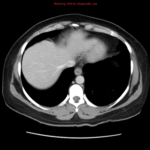 Appendiceal mucinous cystadenoma (Radiopaedia 8263-9111 Axial liver window 14).jpg
