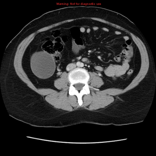 Appendiceal mucinous cystadenoma (Radiopaedia 8263-9111 Axial liver window 46).jpg