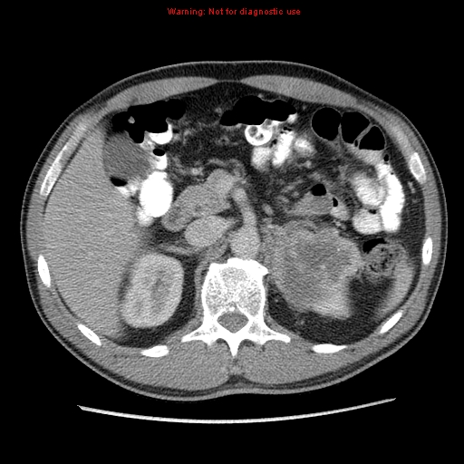 Appendicitis and renal cell carcinoma (Radiopaedia 17063-16760 A 18).jpg
