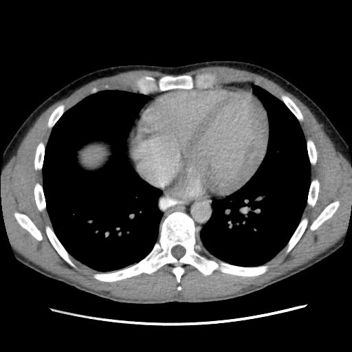 File:Appendicitis complicated by post-operative collection (Radiopaedia 35595-37114 A 5).jpg