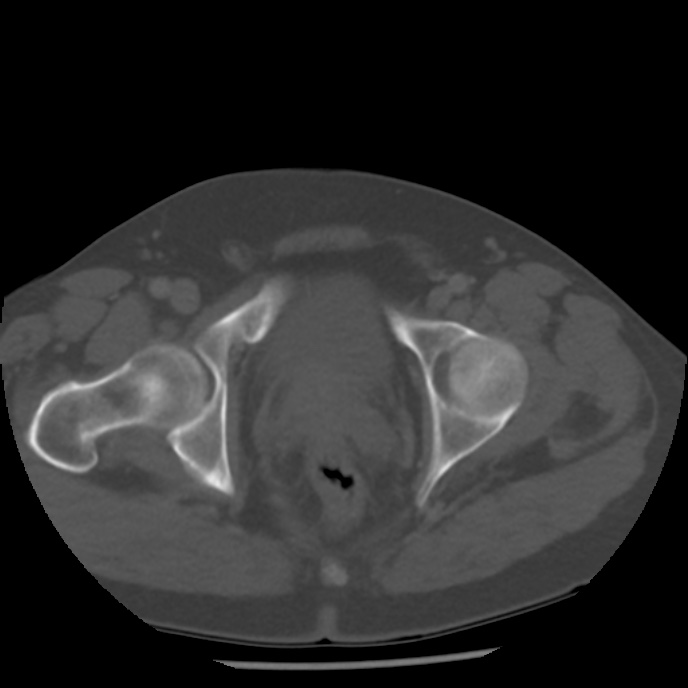 Appendicitis with perforation (Radiopaedia 35790-37342 Axial bone window 51).jpg