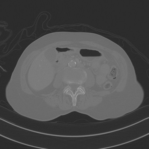 April fools' 2019- calcified peritoneal arachnoidosis (Radiopaedia 67273-76636 Axial bone window 20).png