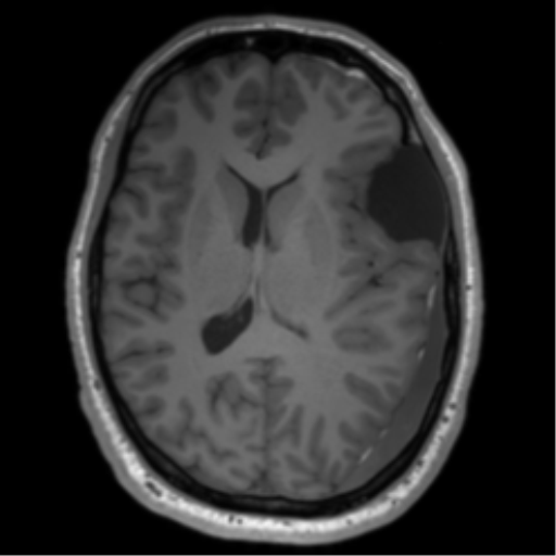 File:Arachnoid cyst with subdural hematoma (Radiopaedia 85892-101743 Axial T1 51).png