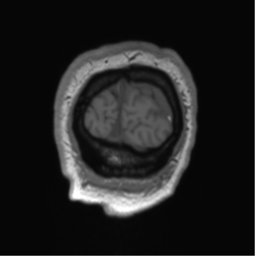 File:Arachnoid cyst with subdural hematoma (Radiopaedia 85892-101743 Coronal T1 4).png