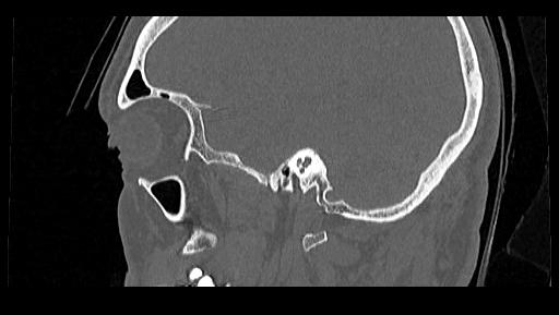 Arcuate foramen (Radiopaedia 89833-106944 Sagittal bone window 120).jpg