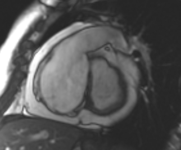 File:Arrhythmogenic right ventricular cardiomyopathy (Radiopaedia 69431-79307 Short axis cine 199).jpg