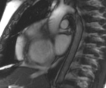 Arrhythmogenic right ventricular cardiomyopathy (Radiopaedia 69431-79307 Short axis cine 244).jpg