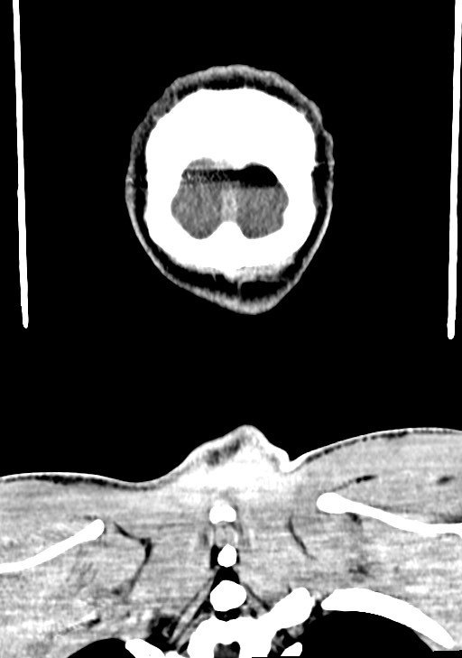 Arrow injury to the brain (Radiopaedia 72101-82607 Coronal non-contrast 69).jpg