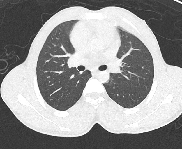 File:Arrow injury to the chest (Radiopaedia 75223-86321 Axial lung window 31).jpg