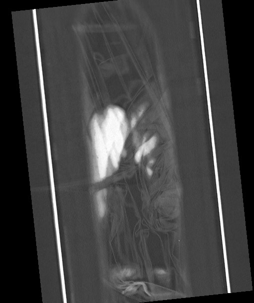 Arrow injury to the chest (Radiopaedia 85367-100975 Coronal lung window 129).jpg