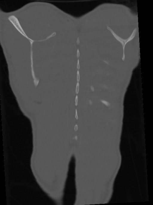 Arrow injury to the neck (Radiopaedia 75225-86323 Coronal bone window 108).jpg
