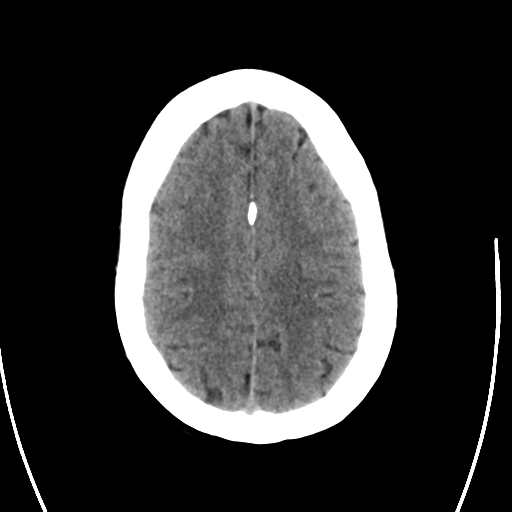 File:Arteriovenous malformation (cerebral) (Radiopaedia 40070-42579 Axial non-contrast 25).png