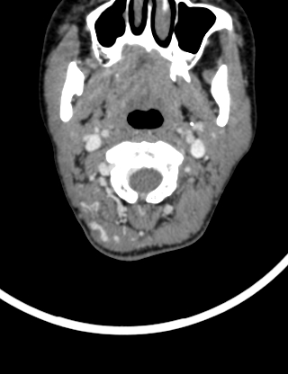 Arteriovenous malformation of the neck (Radiopaedia 53935-60062 B 10).jpg