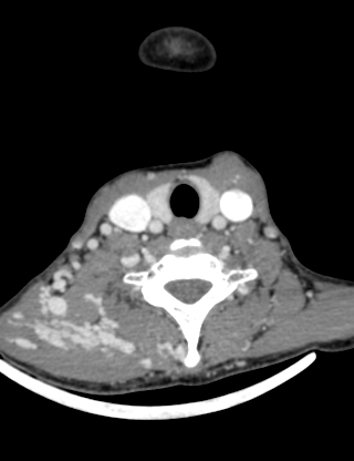 File:Arteriovenous malformation of the neck (Radiopaedia 53935-60062 B 36).jpg