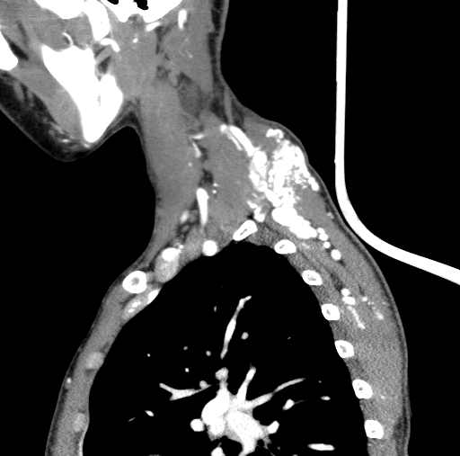 Arteriovenous malformation of the neck (Radiopaedia 53935-60062 C 23).jpg