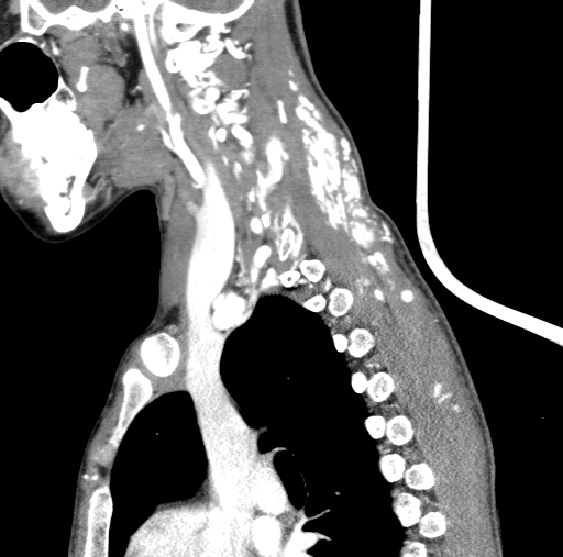 File:Arteriovenous malformation of the neck (Radiopaedia 53935-60062 C 43).jpg