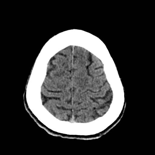 File:Artery of Percheron infarct (Radiopaedia 48088-52893 Axial non-contrast 33).jpg