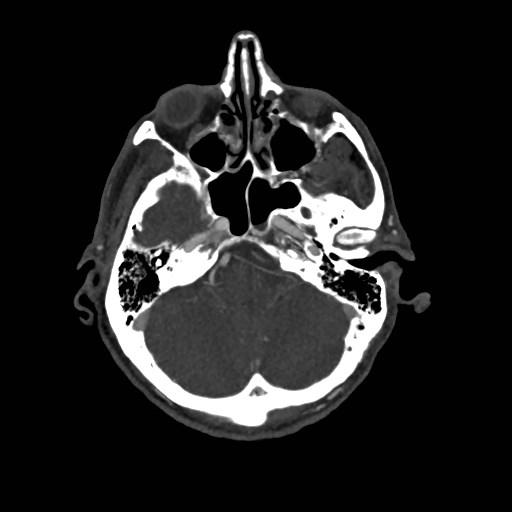 Artery of Percheron infarct (Radiopaedia 48088-52894 A 115).jpg