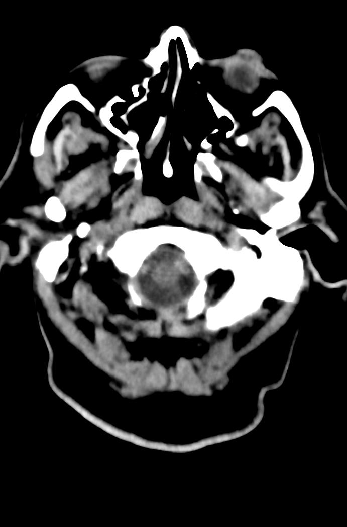 Artery of Percheron infarction (Radiopaedia 80613-94202 Axial non-contrast 26).jpg