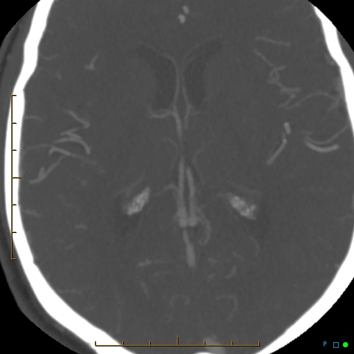 File:Artifactual basilar artery stenosis due to metallic stent (Radiopaedia 31206-31923 A 25).jpg