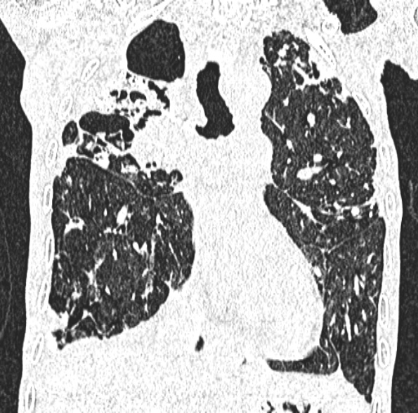 Aspergilloma- with Monod sign (Radiopaedia 44737-48532 Coronal lung window 235).jpg