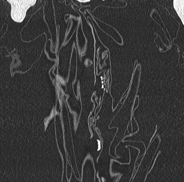 Aspergilloma- with Monod sign (Radiopaedia 44737-48532 Coronal lung window 80).jpg