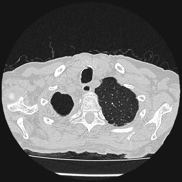 Aspergilloma (Radiopaedia 24458-24763 Axial lung window 7).jpg