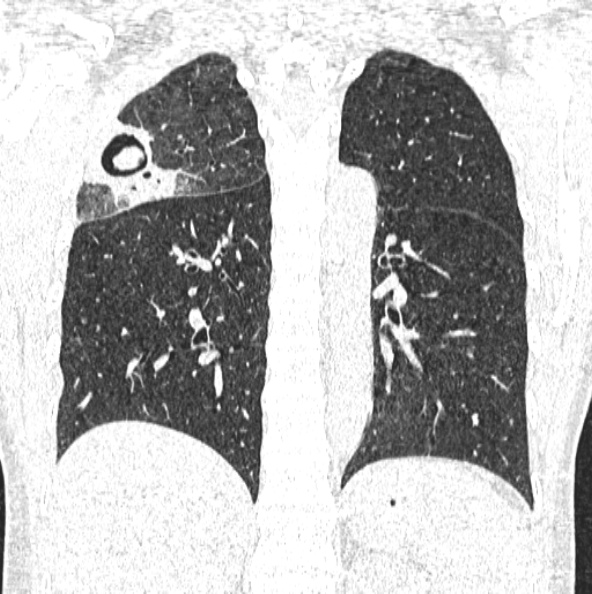 File:Aspergilloma (Radiopaedia 26223-26347 Coronal lung window 36).jpg