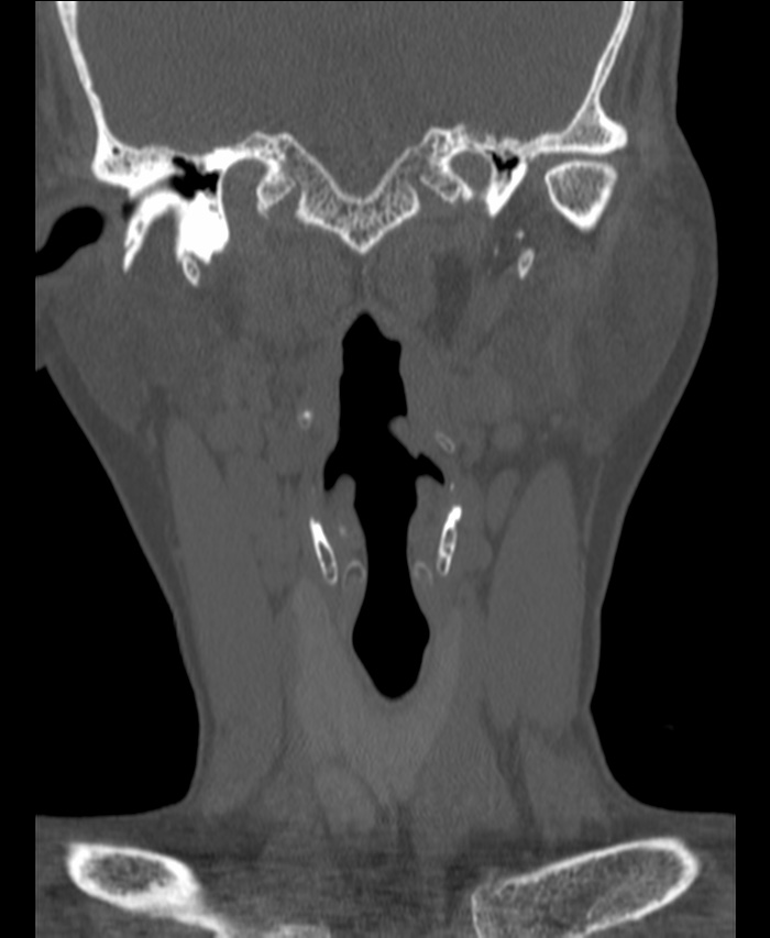 Atlanto-occipital assimilation with basilar invagination (Radiopaedia 70122-80188 Coronal bone window 25).jpg