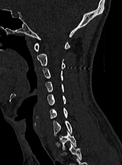 Atlantoaxial subluxation (Radiopaedia 44681-48450 Sagittal bone window 45).jpg
