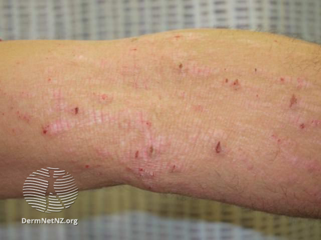 File:Atopic dermatitis (DermNet NZ dermatitis-flexural-eczema26).jpg