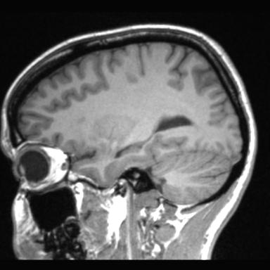Atretic encephalocoele with inferior vermis hypoplasia (Radiopaedia 30443-31108 Sagittal T1 93).jpg