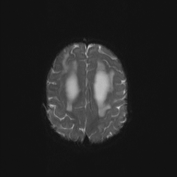 Atypical medulloblastoma (Radiopaedia 34903-36371 Axial DWI 24).jpg