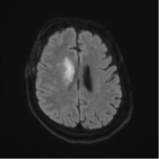 Atypical meningioma (WHO Grade II) (Radiopaedia 54742-60981 Axial DWI 47).png