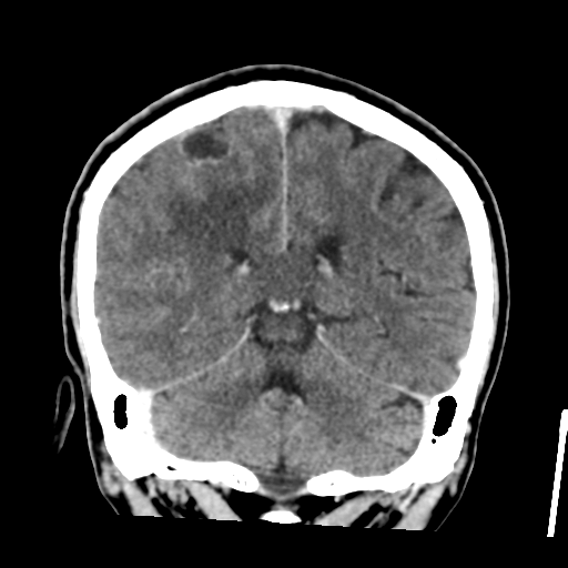 File:Atypical meningioma (WHO grade II) with osseous invasion (Radiopaedia 53654-59715 Coronal C+ delayed 40).png
