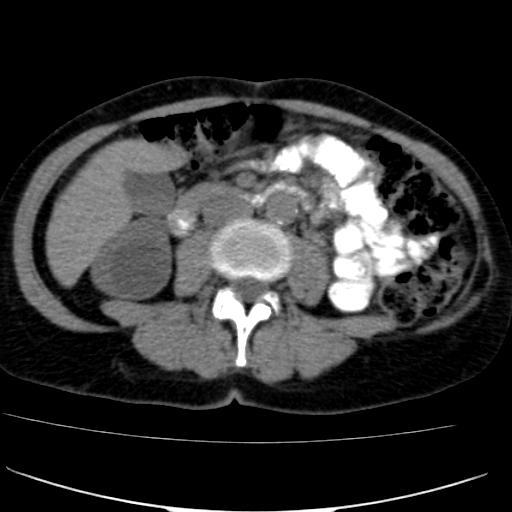 File:Atypical renal cyst (Radiopaedia 17536-17251 non-contrast 23).jpg