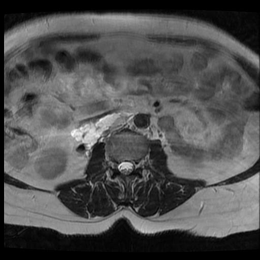 File:Atypical retroperitoneal lymphocoeles with large leiomyoma of uterus (Radiopaedia 32084-33027 Axial T2 1).jpg