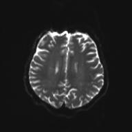 Autoimmune limbic encephalitis (Radiopaedia 30363-31005 Axial B0 and DWI 22).jpg