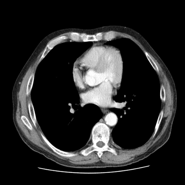 Autosomal dominant polycystic kidney disease (Radiopaedia 27851-28094 B 35).jpg
