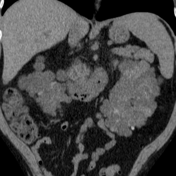 File:Autosomal dominant polycystic kidney disease (Radiopaedia 36539-38101 Coronal non-contrast 18).jpg