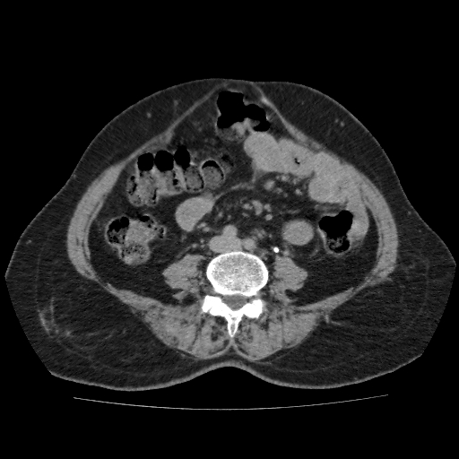File:Autosomal dominant polycystic kidney disease (Radiopaedia 38189-40194 Axial C+ delayed 34).jpg